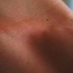 Natural Ways to Treat Hives and Relieve Inflammation