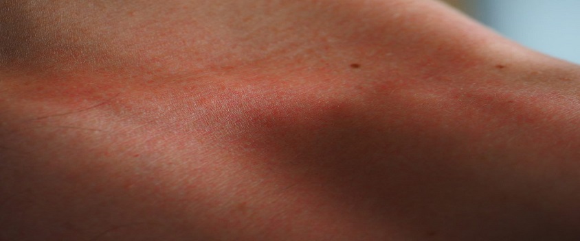 Natural Ways to Treat Hives and Relieve Inflammation